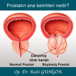 Prostat Belirtileri
